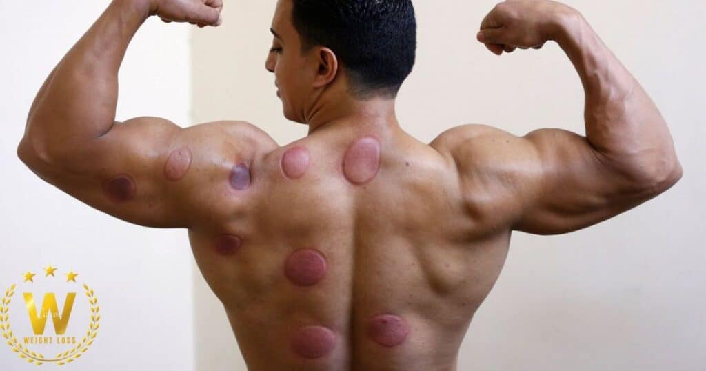 5 Amazing Health Benefits Of Cupping For Weight Loss