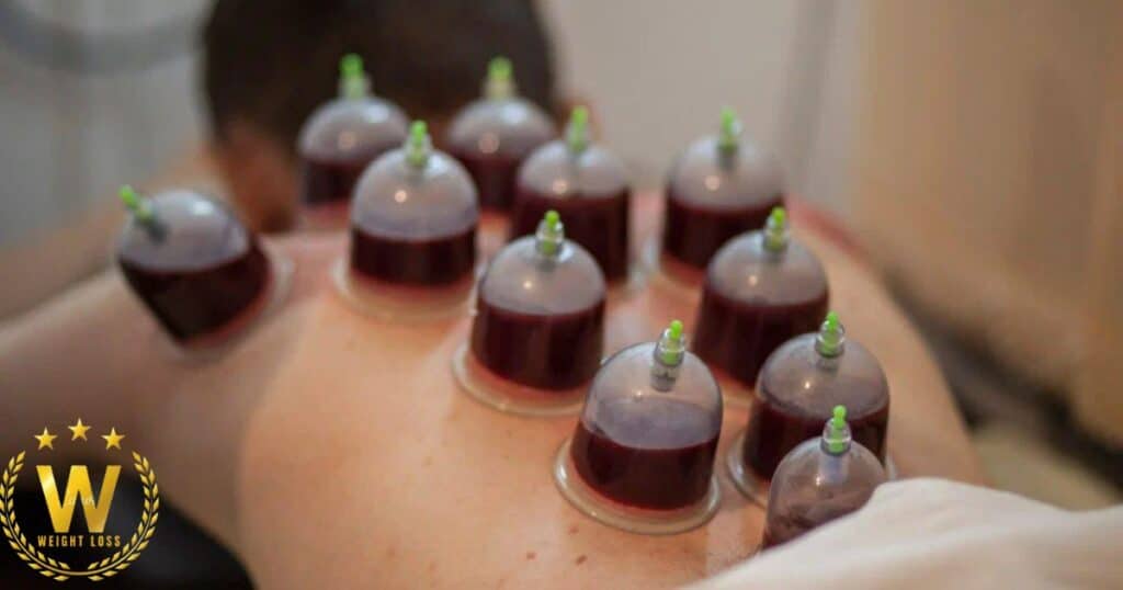 How Frequent Should Cupping Therapy Sessions Be?