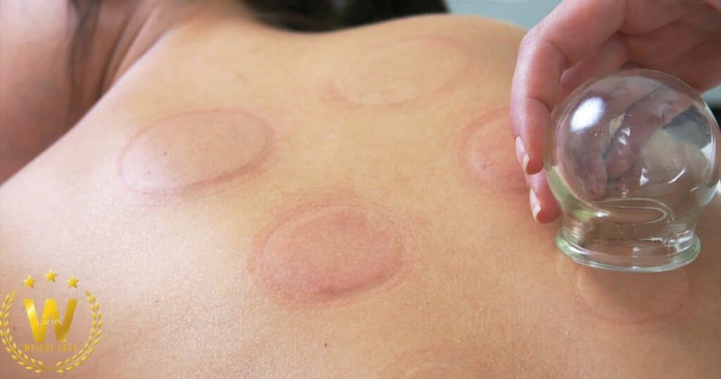 Who Performs Cupping?